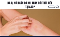 Da Bị Nổi Mẩn Đỏ Khi Thay Đổi Thời Tiết – Tại Sao?