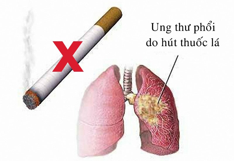 Ung thư phổi do khói thuốc lá