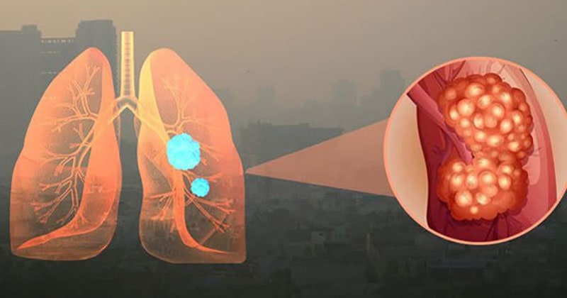 Ung thư phổi do ô nhiễm không khí